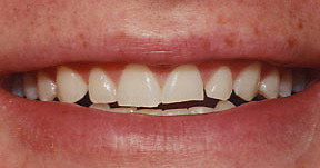Porcelain Veneers Gallery Case 11 