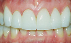 Porcelain Veneers Gallery Case 12 