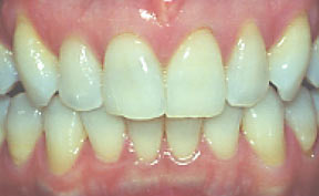 Porcelain Veneers Gallery Case 12 