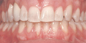 Porcelain Veneers Gallery Case 6 