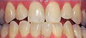 Teeth Whitening Gallery Case 1 