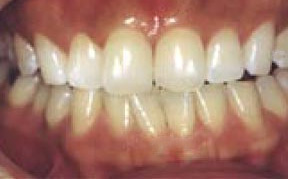 Teeth Whitening Gallery Case 2 