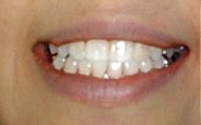 Teeth Whitening Gallery Case 3 