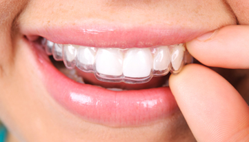 Is It Faster Than Braces