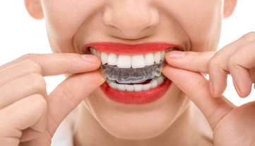 Straightening Your Teeth