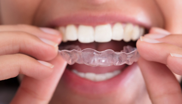 What Is Invisalign 1