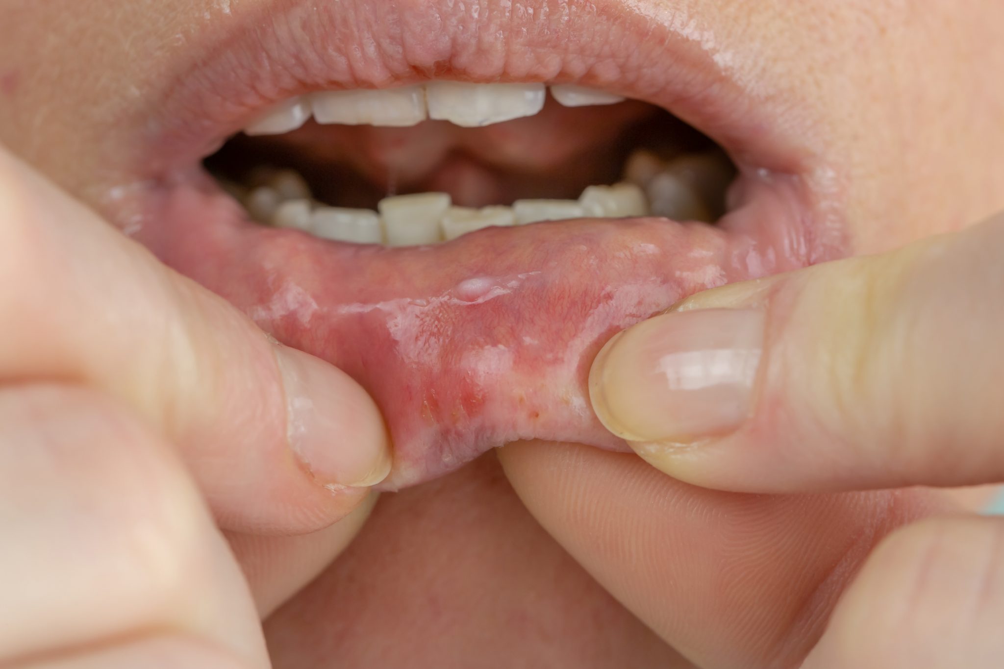 Woman With Aphthae On Lip